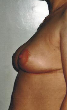 Podniesienie piersi - po operacji
