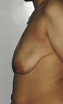 Podniesienie piersi - przed operacjÄ…