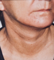 UsuniÄ™cie zmarszczek twarzy i szyi - po