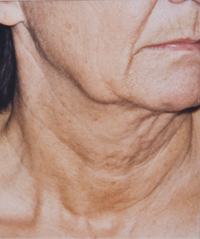 UsuniÄ™cie zmarszczek twarzy i szyi - przed